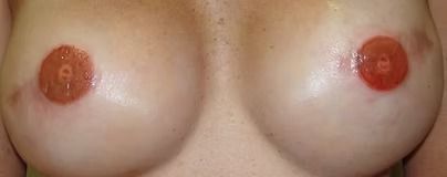 Close-up of a bare chest with red circular patches on both sides, showing breast tips.