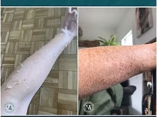 Split-view of a forearm: left side smooth and hairless, right side covered in visible hair and freckles.