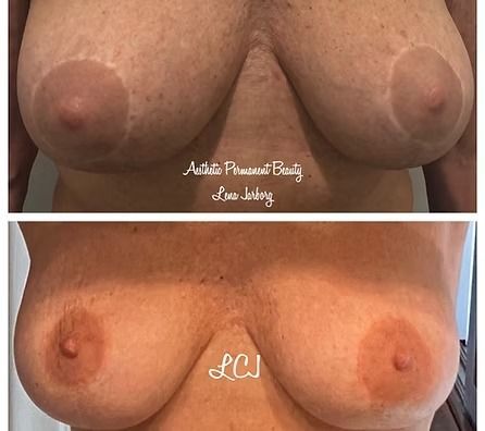 Before-and-after close-up of a chest, with two side-by-side photos showing different nipple shape and position.