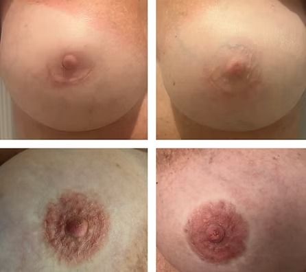 Four close-up views of a breast nipple and areola, showing varying redness and texture.