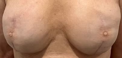 Close-up of an adult torso in a white bra, showing breasts and upper chest.