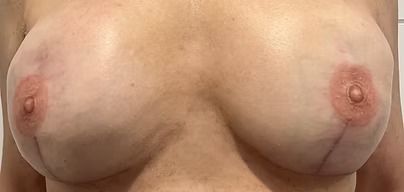 Close-up of bare female chest with visible swelling and enlarged breasts
