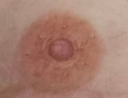 Close-up of a circular skin rash with a pink raised center and reddish-brown surrounding area.