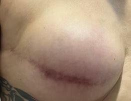 Close-up of a shoulder with a red-purple bruise or surgical scar across the skin
