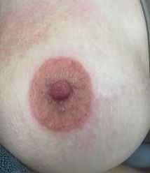 Close-up of a nipple and areola with a reddish circular rash around it