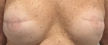 Close-up of a bare chest with visible breasts and light freckles on the skin.