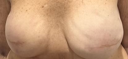 Close-up of a person's bare chest and breasts against a plain background