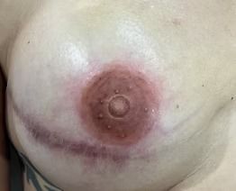 Close-up of a bare chest with a breast and nipple centered in frame, reddish skin around it
