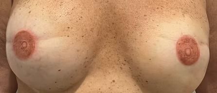 Close-up of bare chest with both breasts visible, each with a round brown nipple.