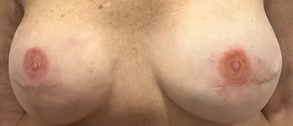 Close-up of a person's chest with visible breast tissue and nipples against a plain background