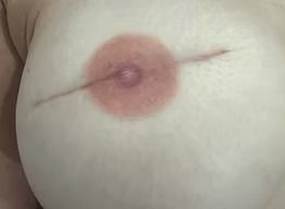 Close-up of a breast with a circular red rash around the nipple and a thin linear scar or mark across it