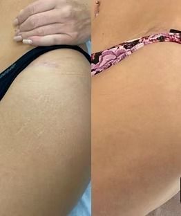 Side-by-side close-up of a hip in black underwear, showing before-and-after skin texture changes.