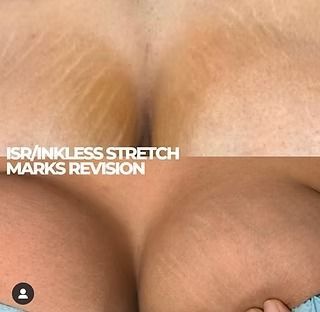 Before-and-after close-up of skin with stretch marks, labeled “stretch marks revision”
