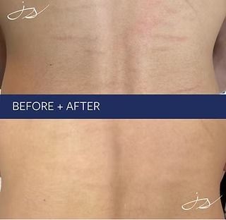 Before-and-after back photo showing reduced stretch marks after treatment