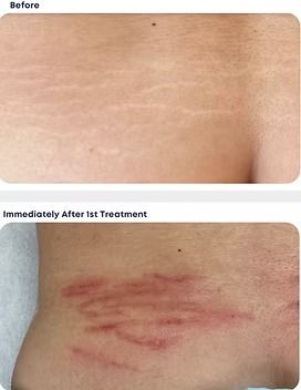 Before-and-after skin photo showing faint lines, then red treatment marks on a back/side torso area