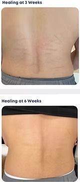 Healing scars at 3 and 6 weeks on a person’s lower back, shown before and after recovery