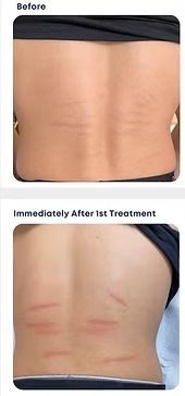 Before-and-after torso photos showing skin treatment marks and redness on the side and lower back