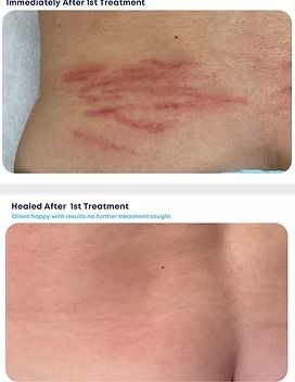 Skin rash before and after treatment, showing red irritated marks healing to clear skin.