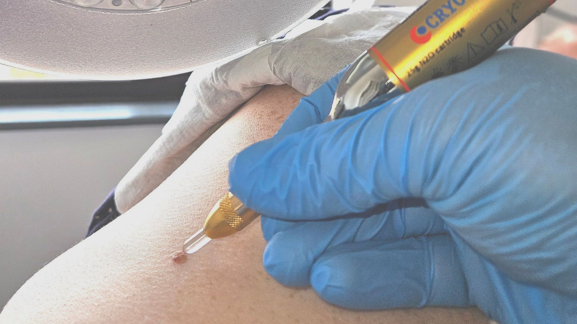 Skin Lesion Removal Mole Warts Skin Tag Cryotherapy 