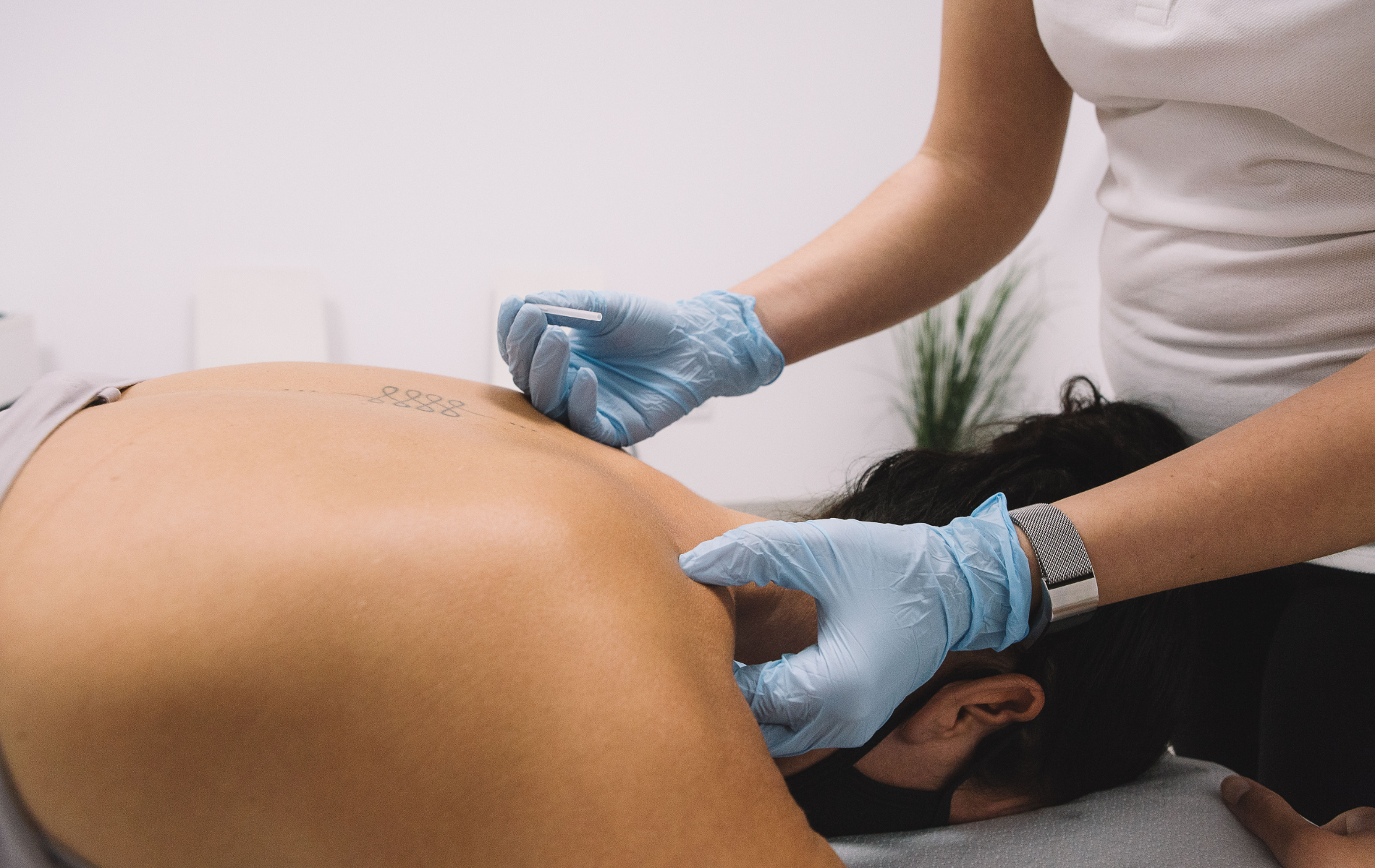 Person receiving dry needling therapy on their back, hands in blue gloves.
