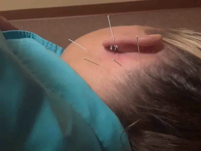 Hands inserting acupuncture needles into a person's abdomen, on a white towel.