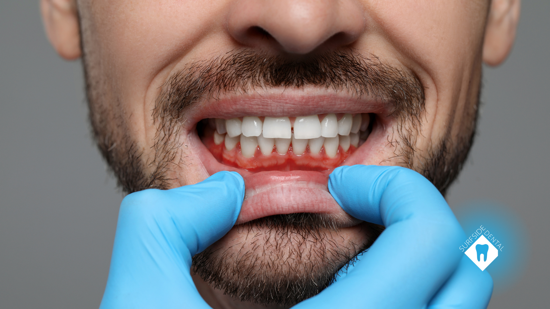 A man with a beard is getting his teeth examined by a dentist.