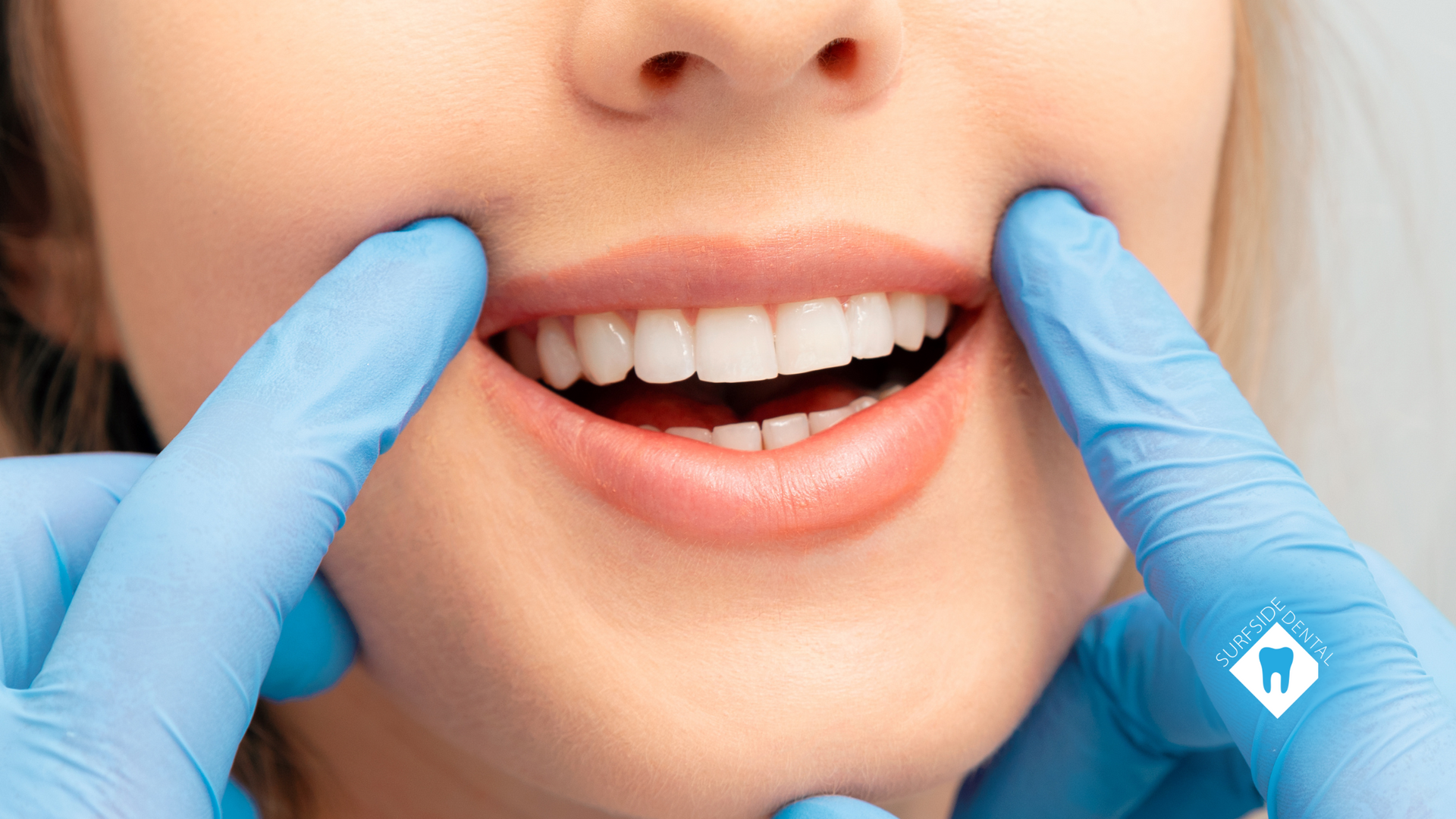 A person's smile is being held open by gloved hands, revealing bright white teeth.