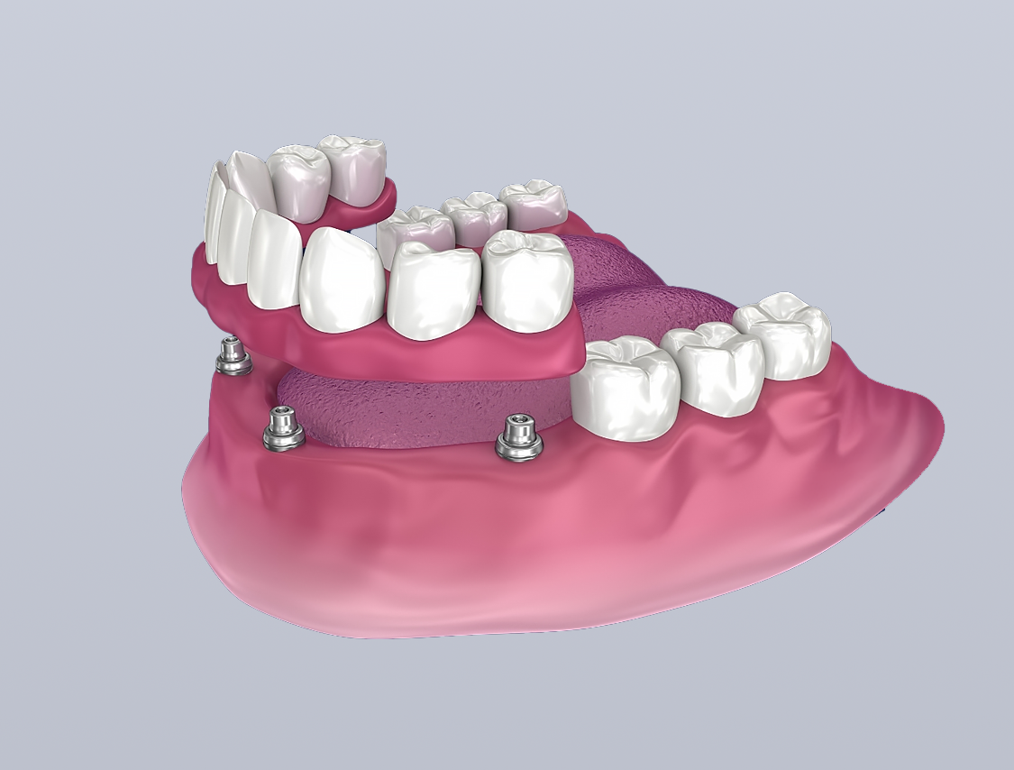 A 3D digital model showing a partial denture being fitted onto dental implants embedded in a pink gum model.