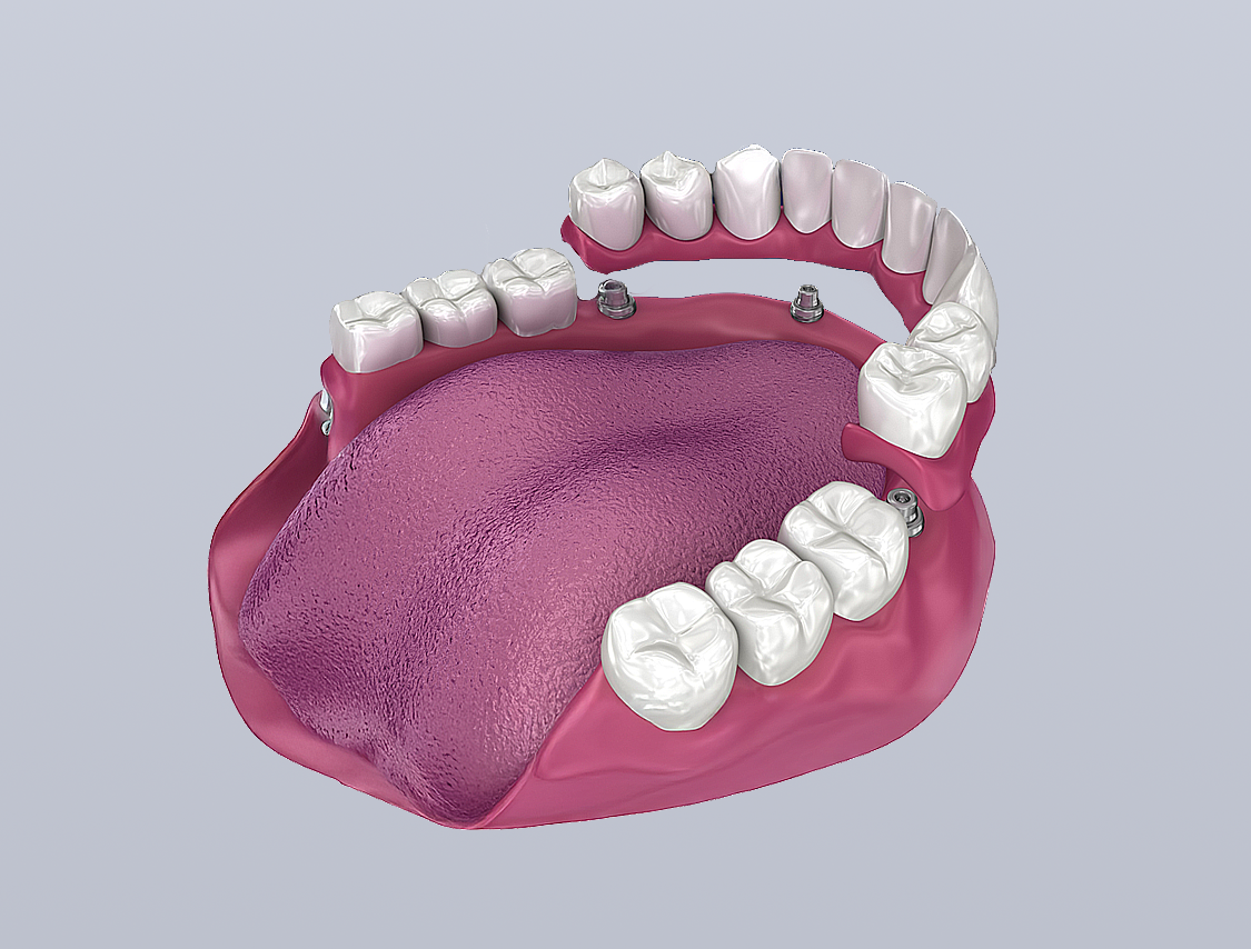 A 3D digital model of a dental implant-supported bridge being positioned onto a pink gum model with remaining teeth.