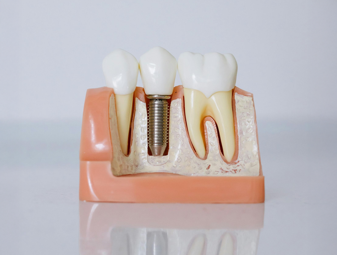 A dental model shows a metal tooth implant placed in the gum between two natural teeth.