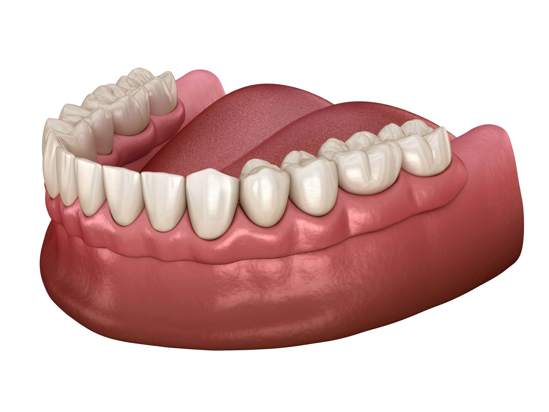Computer generated image of full denture on the bottom jaw