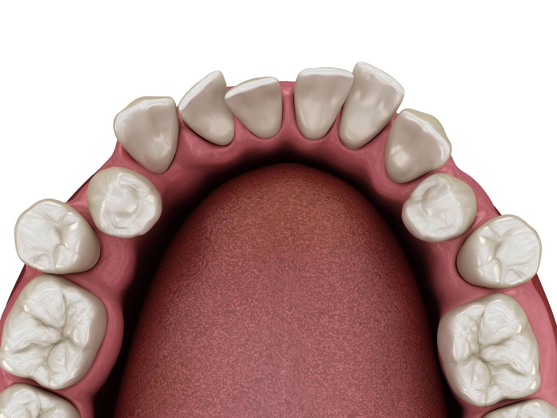 A computer generated image of crowded teeth