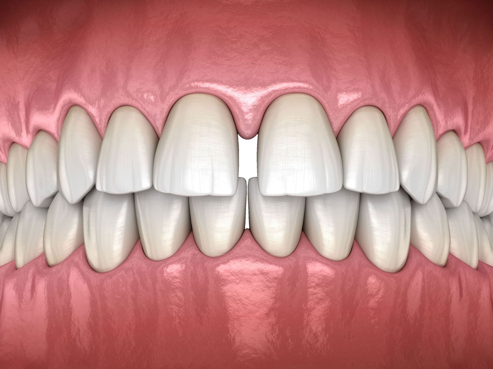 A computer generated image of gapped teeth