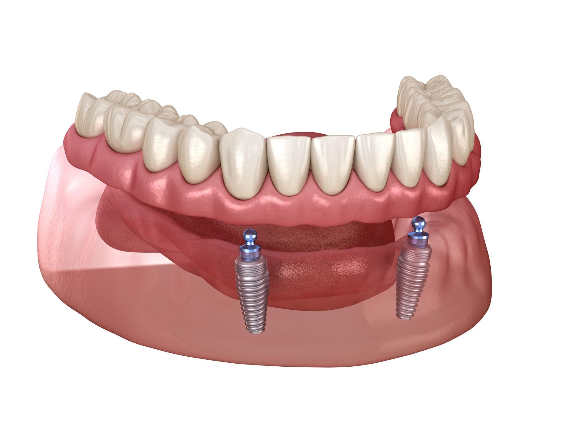 Computer generated image of an implant-supported denture on the bottom jaw
