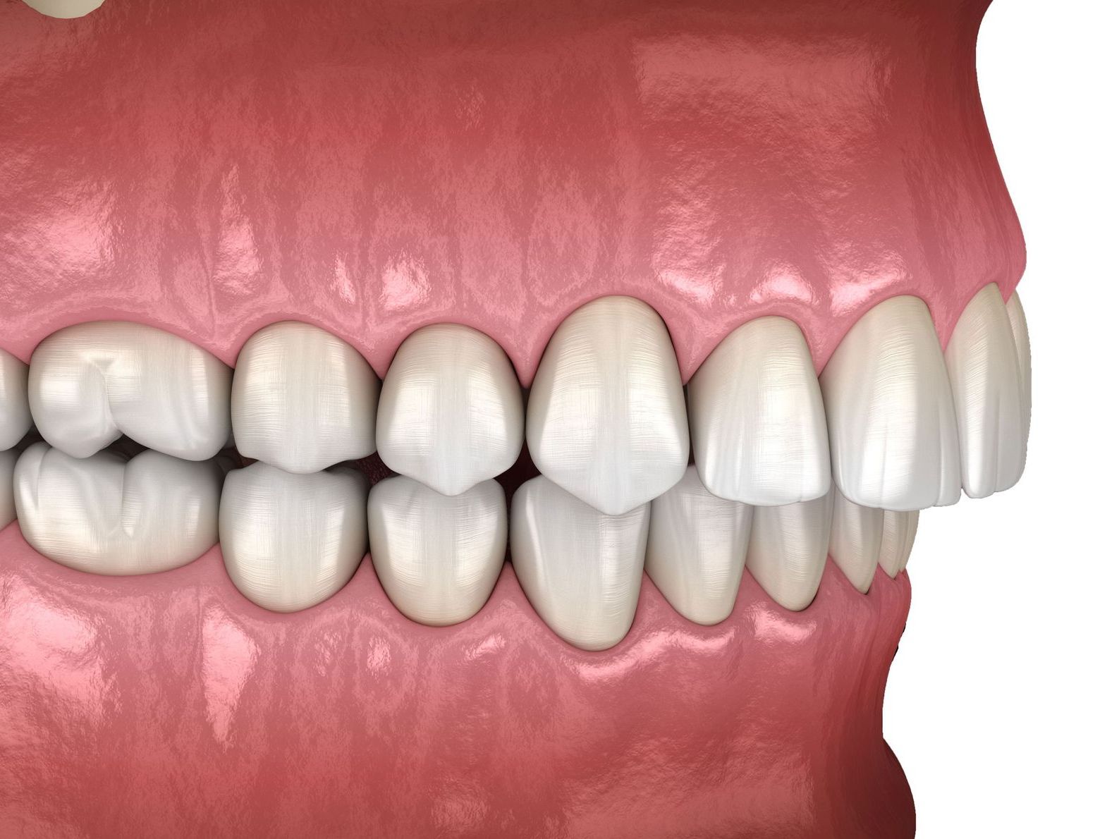 A computer generated image of teeth with an overbite
