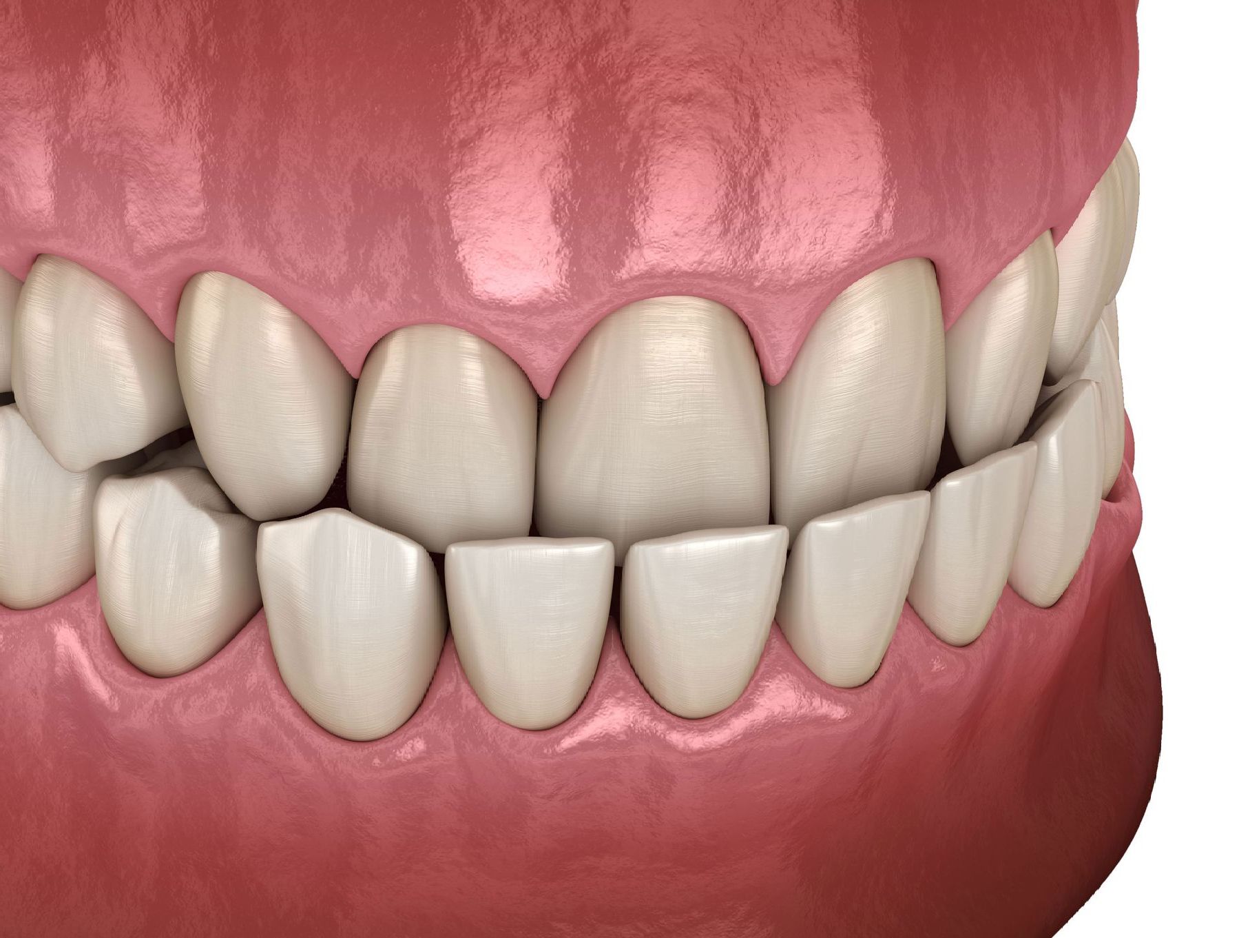 A computer generated image of teeth with an underbite