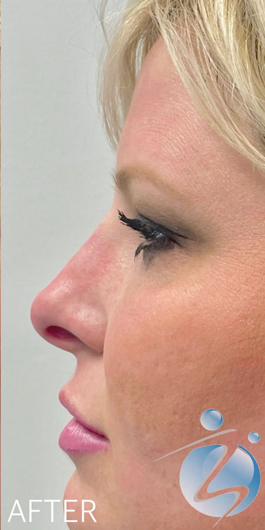 A close up of a woman 's face after a nose job.