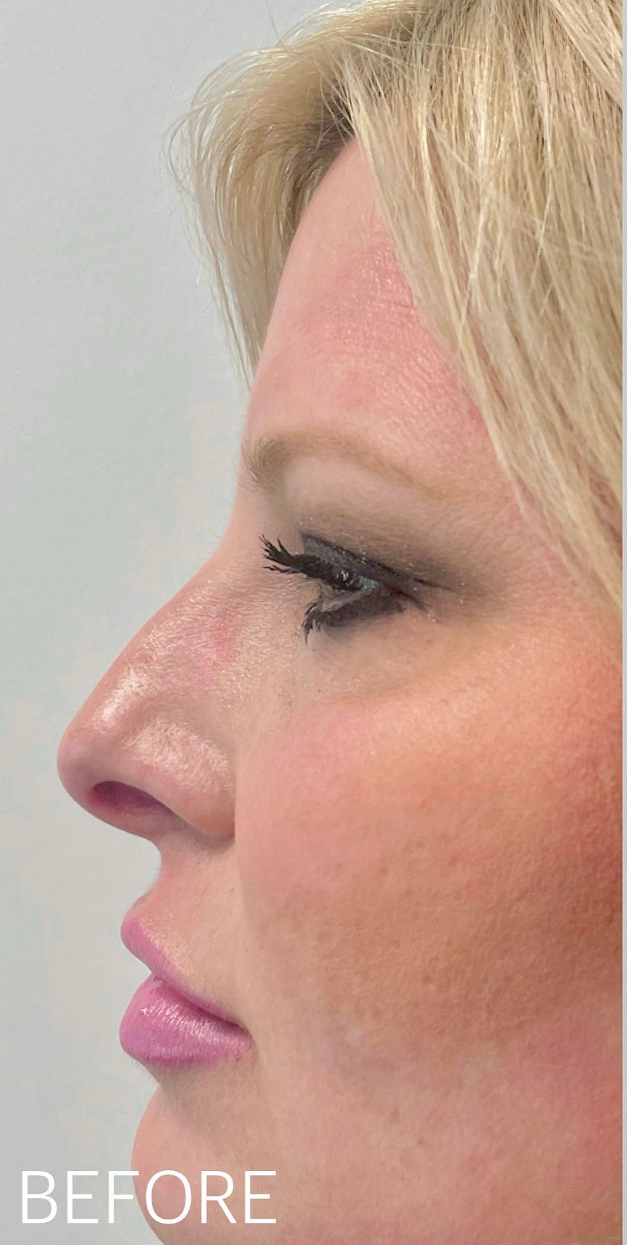 A close up of a woman 's face before a nose job.