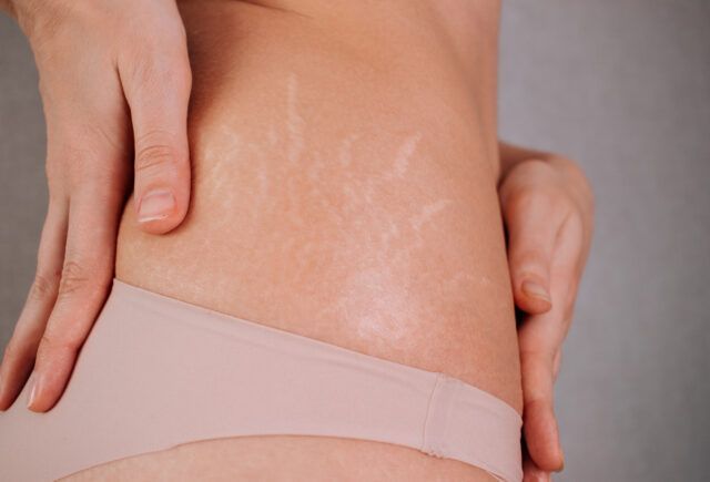 A woman is holding her stomach with stretch marks on it.