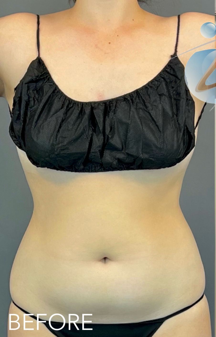 A woman 's torso is shown in a before photo