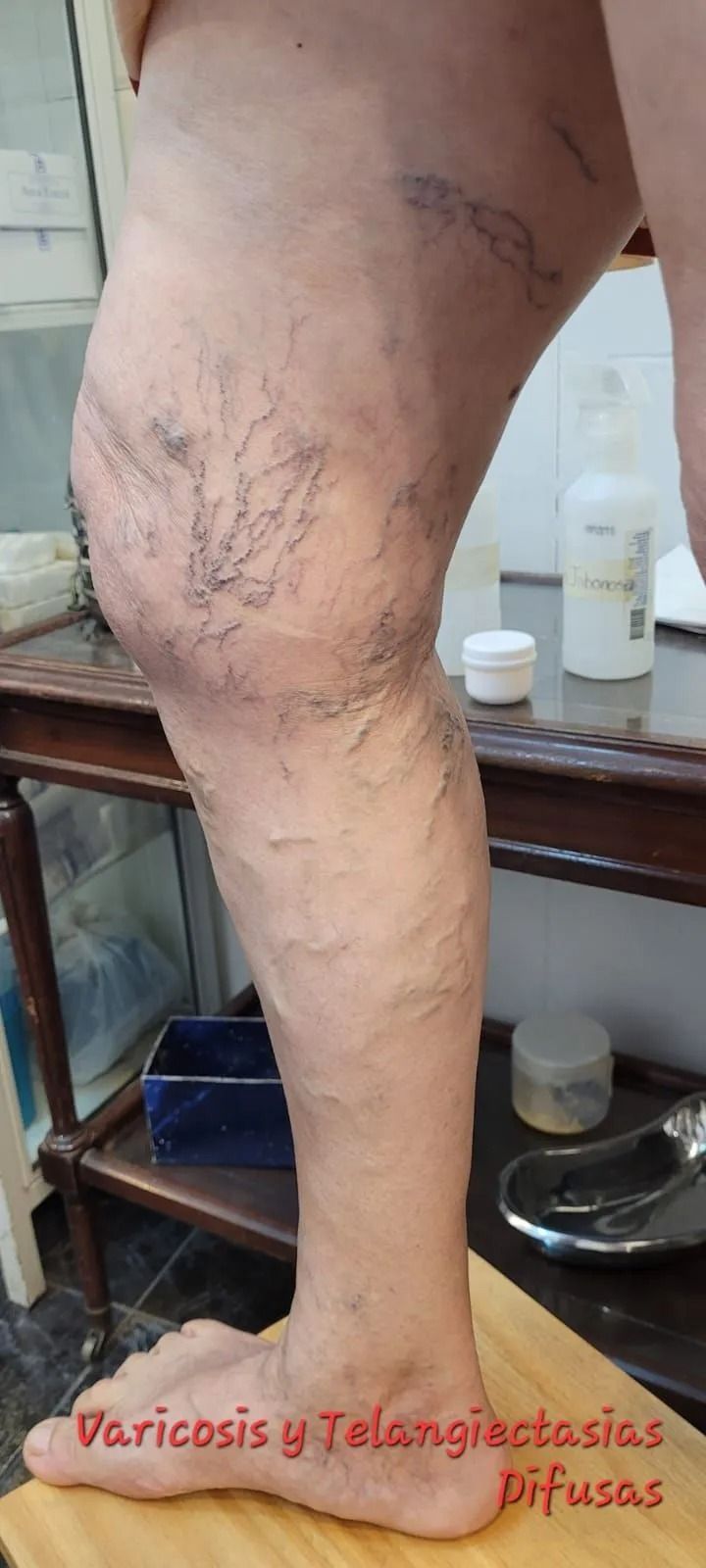Primer plano de una pierna con venas varicosas y telangiectasias visibles, etiquetada como 