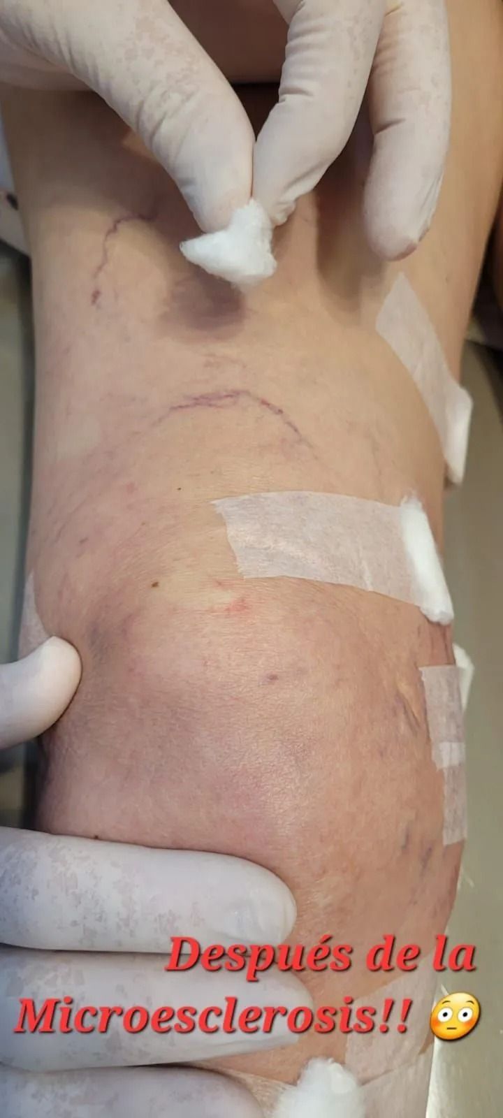Unas manos enguantadas examinan un abdomen magullado y vendado tras un tratamiento de microescleroterapia.