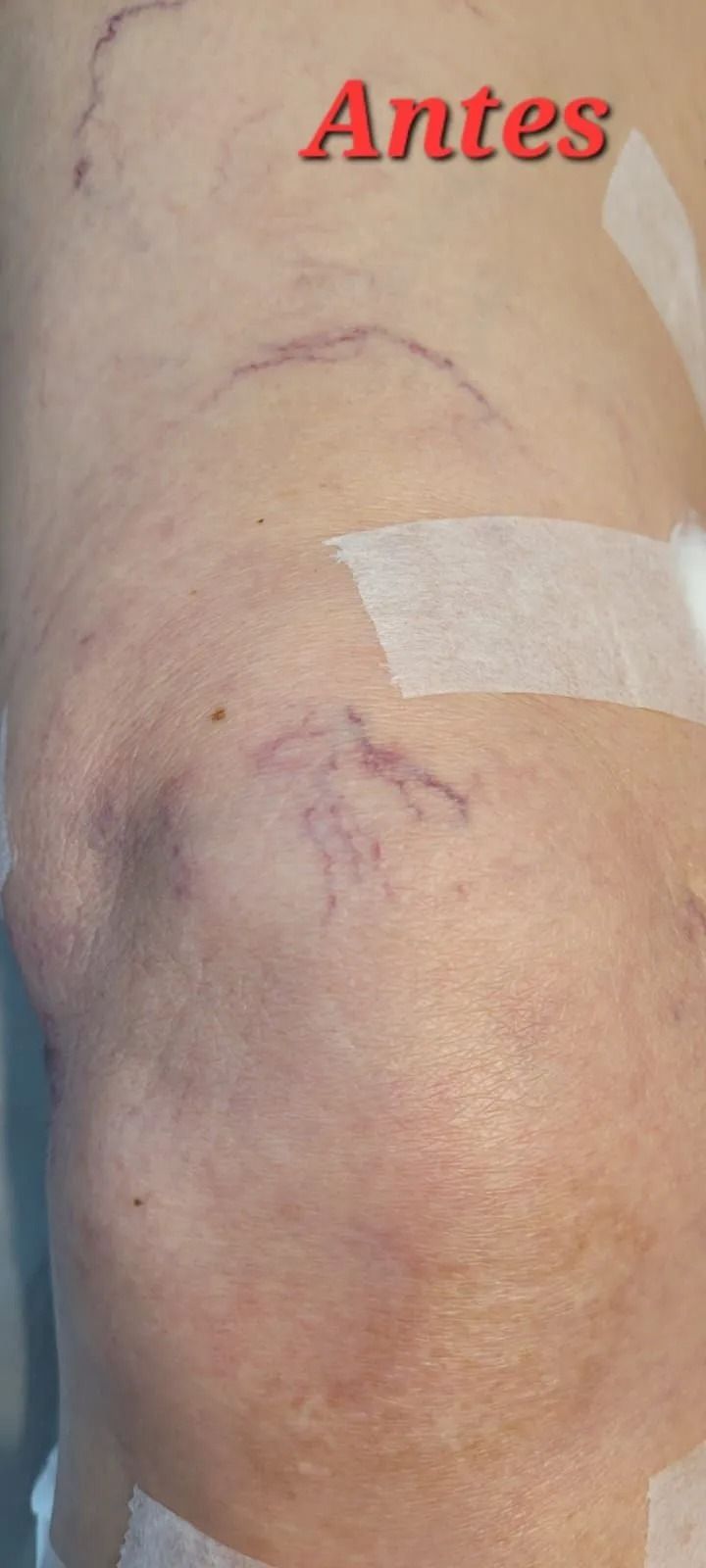 Primer plano de una rodilla con hematomas morados y vendaje, con la palabra 