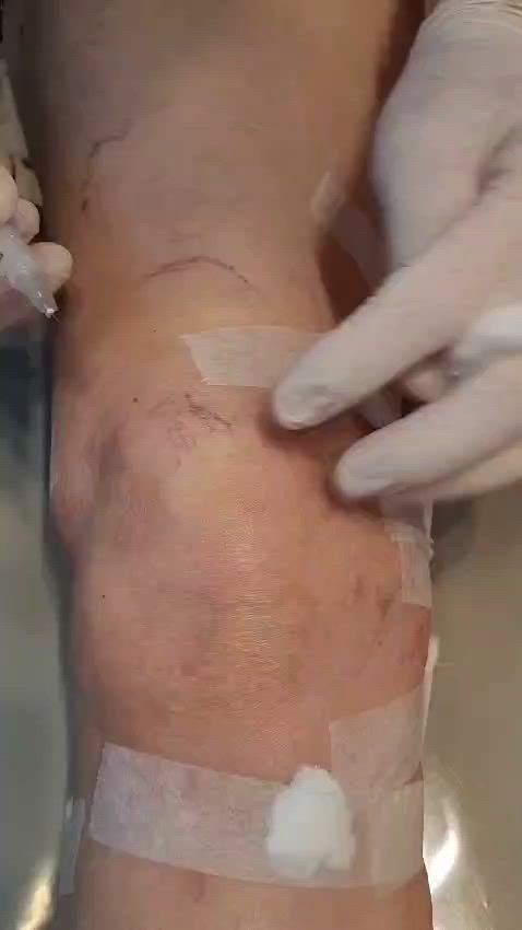 Primer plano de una rodilla vendada con una mano enguantada presionando la piel.
