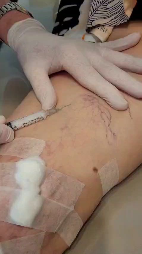 Manos enguantadas insertando una aguja en el muslo de un paciente, con gasa y cinta adhesiva sobre la piel.