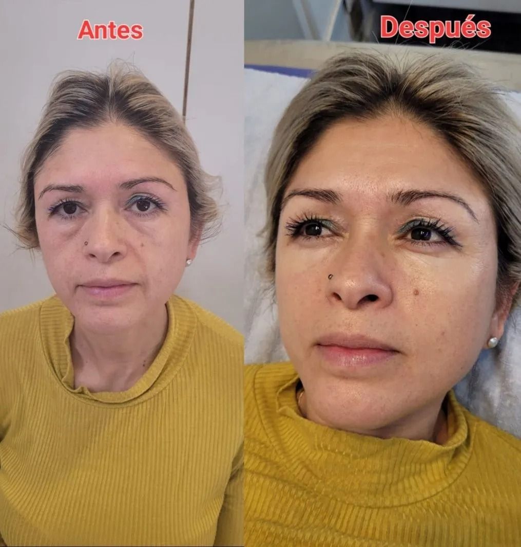 Fotos del rostro de la misma persona antes y después, vistiendo un suéter amarillo, etiquetadas como