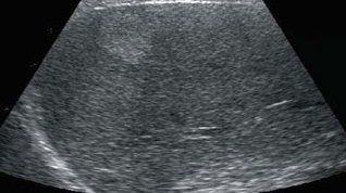 Echographie  Abdominale