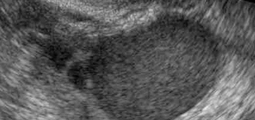 Echographie Endorectale-Endovaginale