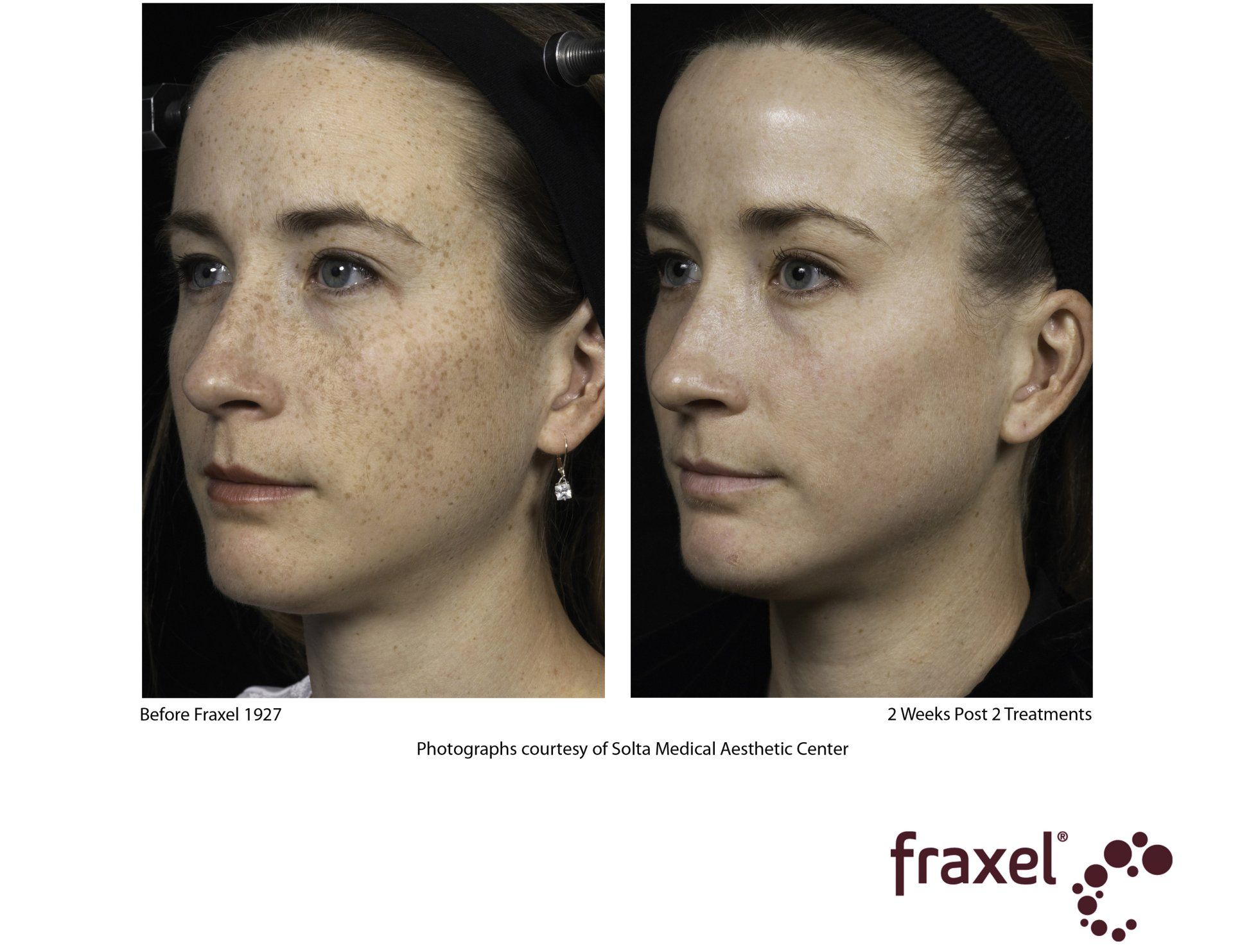 before and after Fraxel laser treatment on freckles