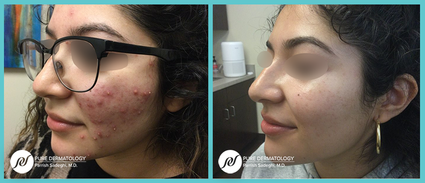 patient before and after Acne treatment at Pure Dermatology